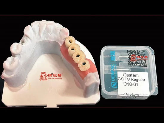 Implant Dentures Crowns with Excellent Dental Prosthesis More Comfortable and Beautiful Than Traditional Movable Dentures and Bridges
