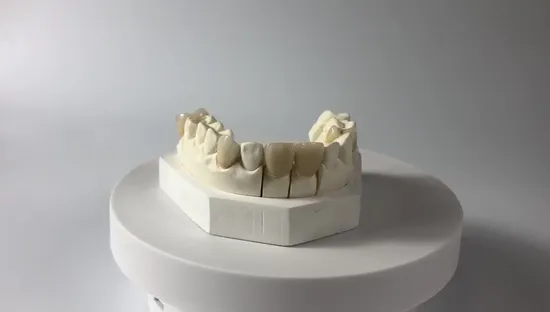 High Quality Dental Implant Emax Dental Inlays and Crowns with High Aesthetic