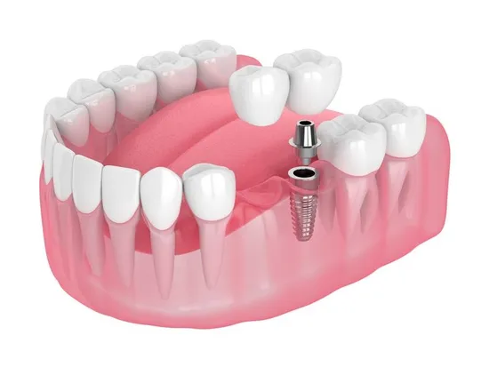 Designed Lab Dental Zirconia Implant Crowns and Bridge Over Titanium Bar