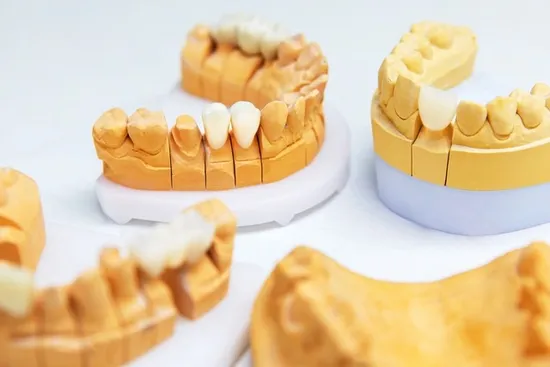 Implant Dentures Crowns with Excellent Dental Prosthesis More Comfortable and Beautiful Than Traditional Movable Dentures and Bridges