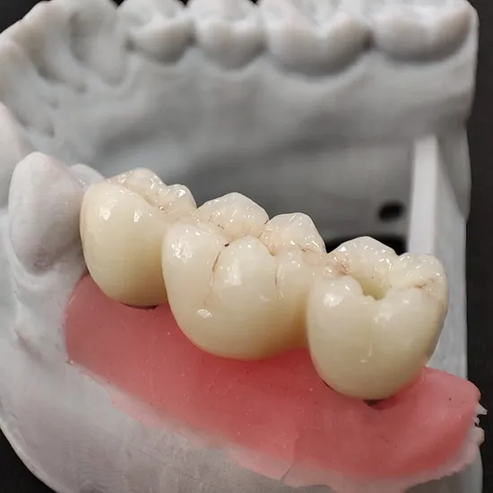 Fast Cement and Save Time Implant Products Dental Zirconia Crowns with Ti Base