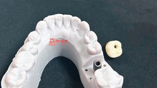 Dental Implant Screw Retained Zirconia Crowns Restorations Custom Hybrid Abutment En China Dental Lab