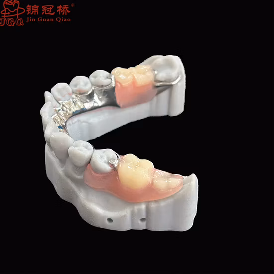 High Quality Removable Metal Framework Denture