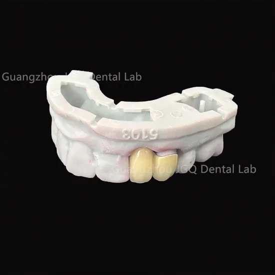 China Dental Lab Artificial Teeth Pfm Crowns and Bridges Good Price Oral Scan Files FDA Approved 