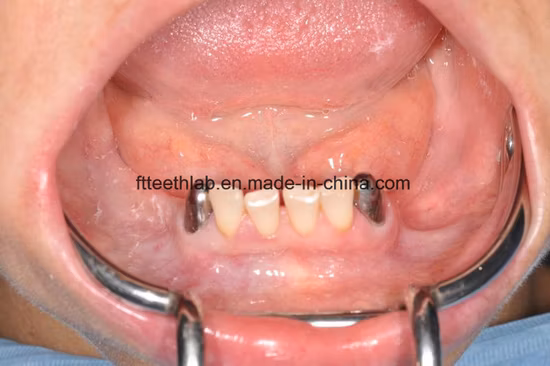 Removable Telescope Metal Cast Partial Dentures Made in China Dental Lab