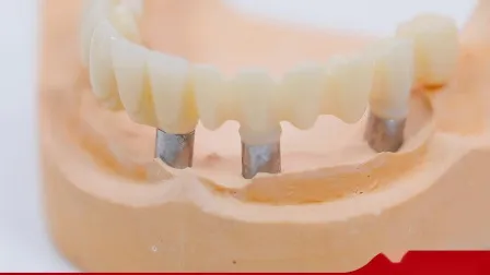 Dental Material Supplies Lab Custom Removable Telescopic Overdenture Removable Denture 